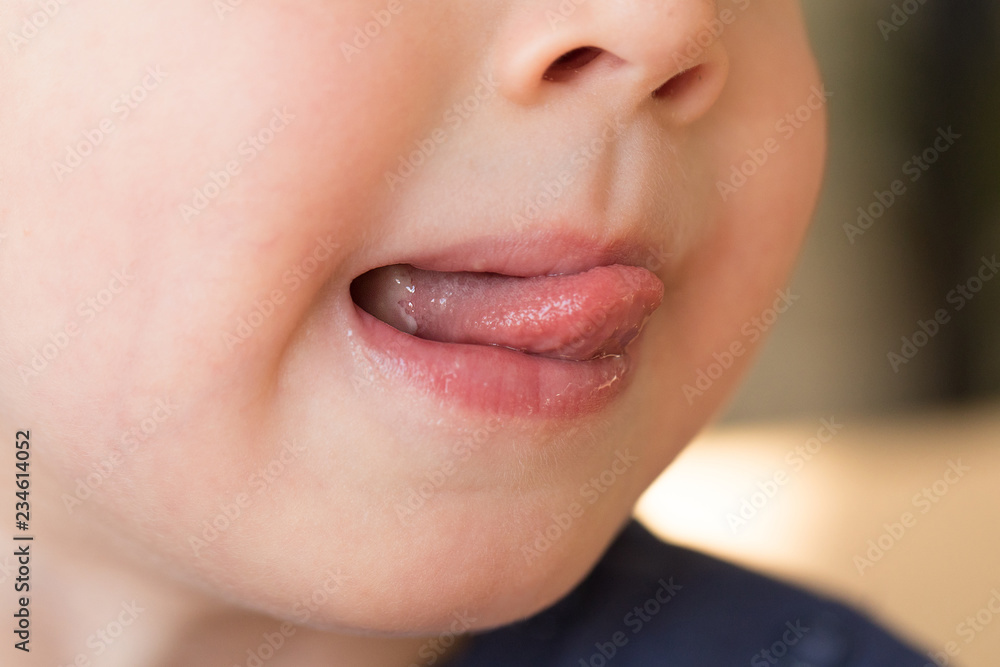 Obraz premium Close-up of child with aphtha or stomatits on mouth