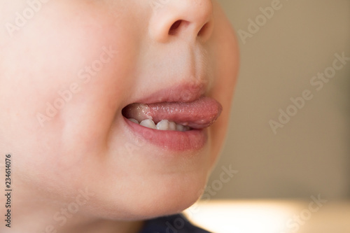 Close-up of Little kid boy with Aphtha or Stomatitis or canker on tongue in his mouth photo