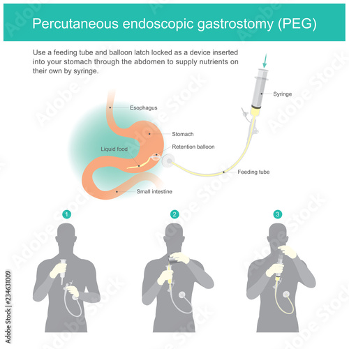 Percutaneous endoscopic gastrostomy (PEG)