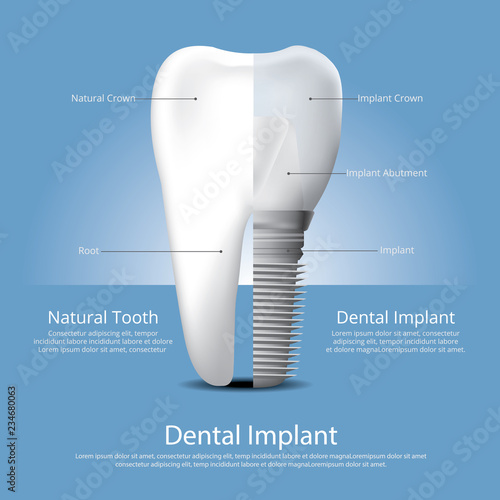 Fototapeta Naklejka Na Ścianę i Meble -  Human teeth and Dental implant Vector Illustration
