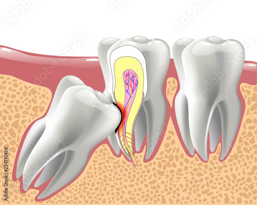 realistic 3D teeth, and wisdom tooth problems
