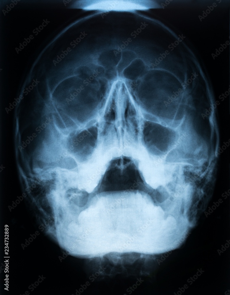 Xray film of a skull of a patient with paranasal sinus with acute right maxillary sinusitis with air fluid level Xray film of a skull of a patient with paranasal sinus with acute right maxillary sinusitis with air fluid level