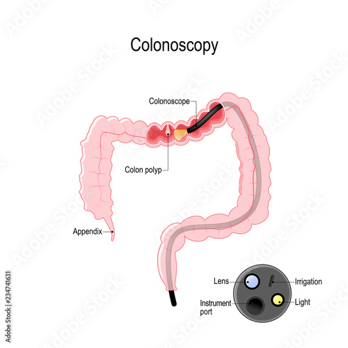 colonoscope in the colon. detail of the colonoscope