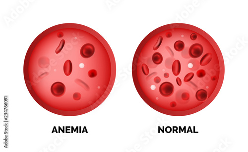 Infographic image of anemia isolated on white background