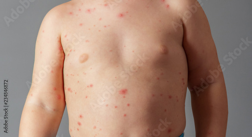 Obraz na plátně Breast and belly of small child with chickenpox