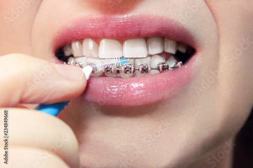Dentist and orthodontist concept. Young woman cleaning and brushing teeth with pink braces using toothbrush