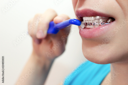 Dentist and orthodontist concept. Young woman cleaning and brushing teeth with pink braces using toothbrush