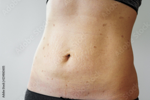 Woman belly with lichen planus photo