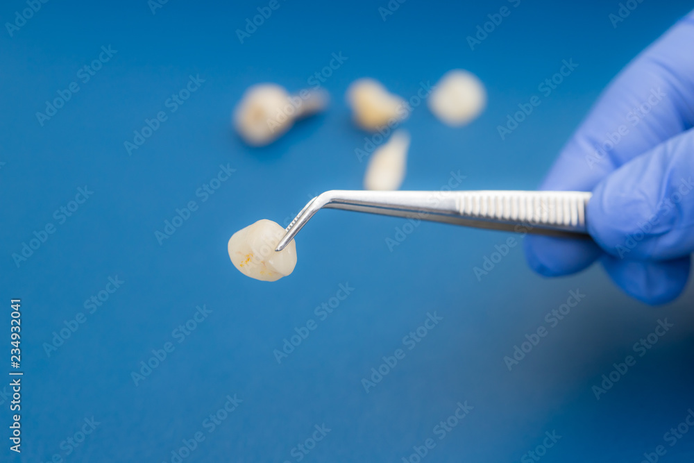 A dentist is holding tweezers for dental ceramic veneers and crowns. A dentist is holding tweezers for dental ceramic veneers and crowns.