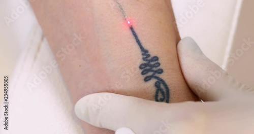 Close-up of laser tattoo removal from woman hand.