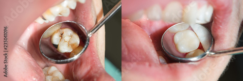 Human teeth close-up during restoration of filling. The concept of aesthetic dentistry