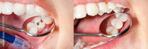 Tableau sur toile Dental caries