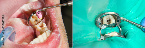 Fotografie endodontic treatment of teeth close-up