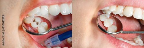 Canvas Print Teeth during treatment close-up in a dental clinic