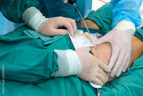 Liposuction surgery in actual operating room. photo