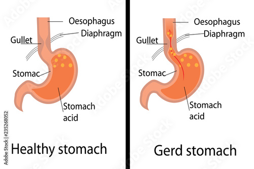 Gastroesophageal acid reflux desease. Gerd and healthy stomach vector illustration