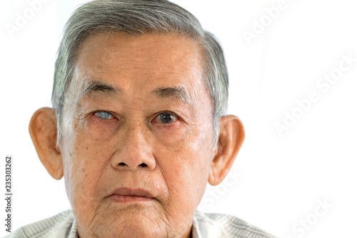 Acute angle glaucoma on right eye and normal eye on left of old asian man.