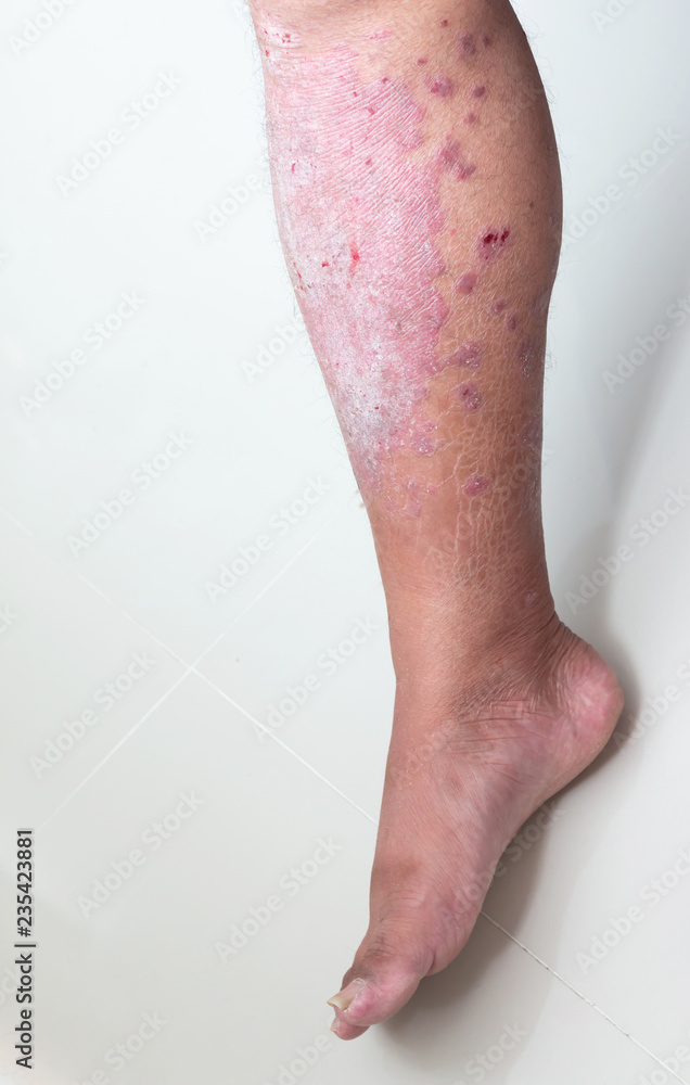 Fototapeta premium Diseases caused by abnormalities of the lymph