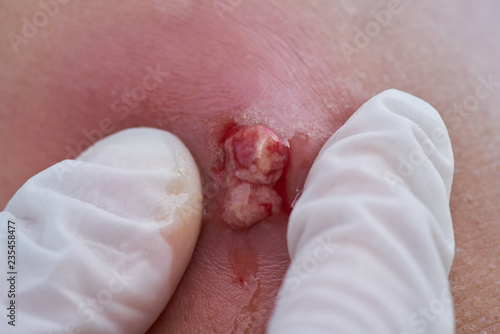 An abscess at the elbow photo