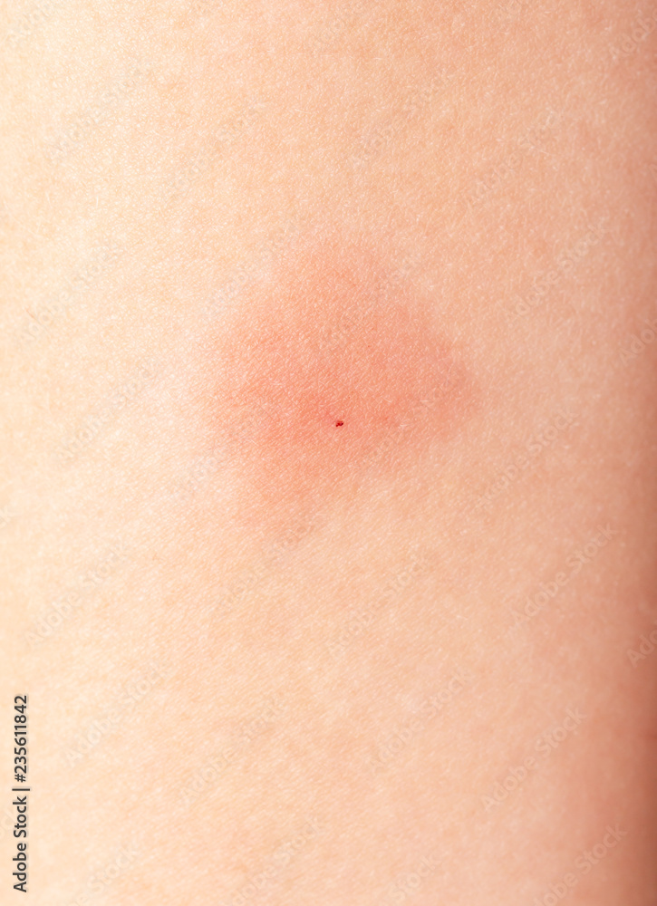 redness on the skin from vaccinations in a child redness on the skin from vaccinations in a child