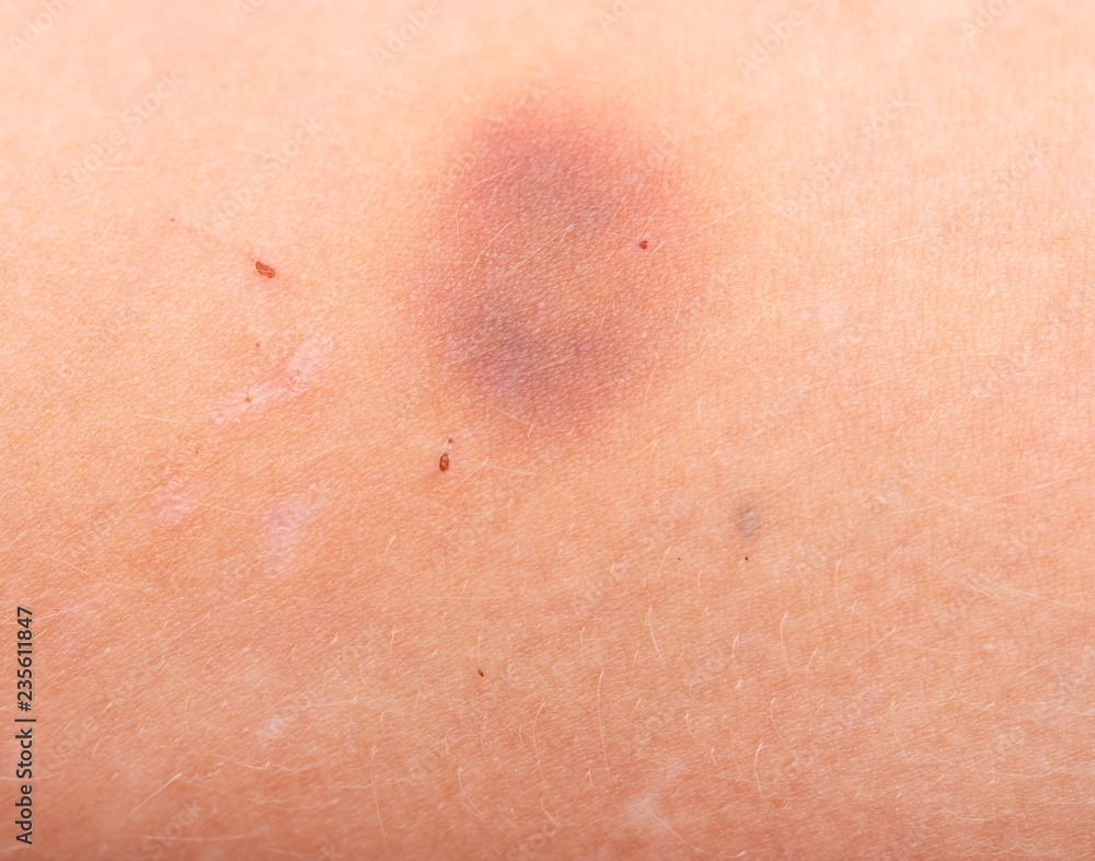 blue-yellow bruise on the arm blue-yellow bruise on the arm