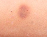 blue-yellow bruise on the arm