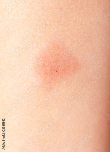 redness on the skin from vaccinations in a child