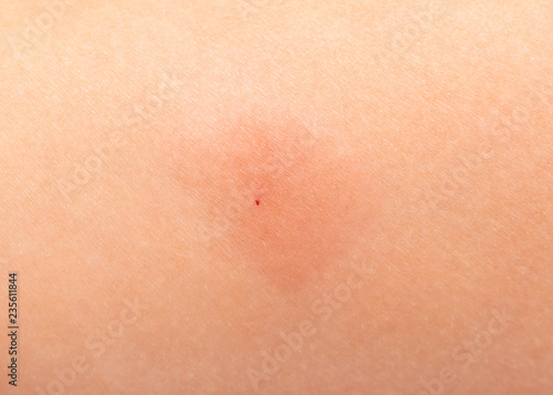 redness on the skin from vaccinations in a child