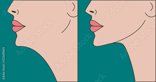 Double chin correction