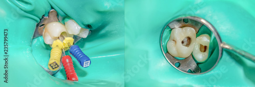 Fotografie photo endodontic treatment of dental canals in the lower molar permanent tooth m