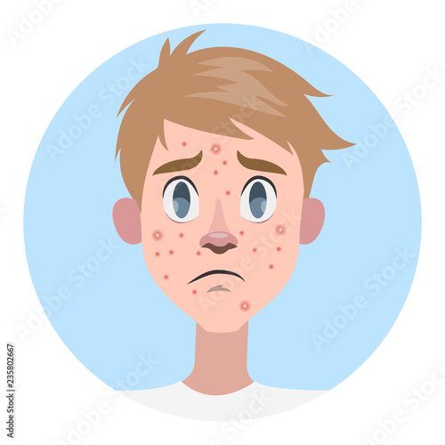 Sad man with acne on the face