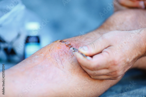 Photography treatment of wound on man's leg with iodine