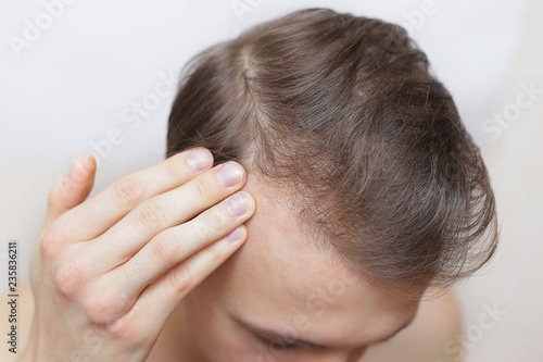 a man is checking his hair for loss. hair loss