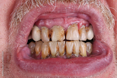 Fotografie The teeth of an elderly man are spoiled by caries, tartar and poor waste  food m