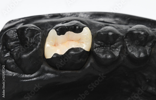 Keramikinlay auf schwarzem Modell