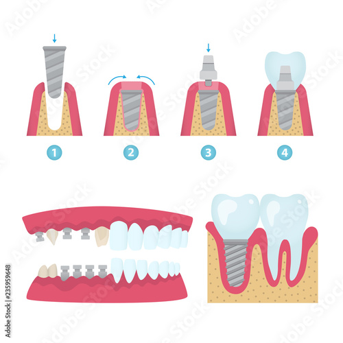 Dental crowns and implantation