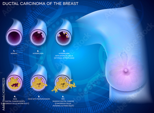 Ductal carcinoma of the breast, detailed medical illustration. At the beginning normal duct, then hyperplasia, after that atypical cells are invading, Ductal cancer in situ and invasive ductal cancer.