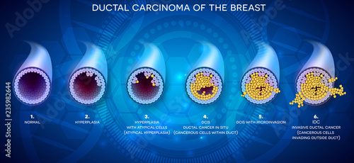 Ductal carcinoma of the breast, detailed medical illustration. At the beginning normal duct, then hyperplasia, after that atypical cells are invading, Ductal cancer in situ and invasive ductal cancer.