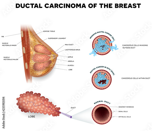 Ductal carcinoma of the breast, detailed medical illustration. Ductal cancer in situ and invasive ductal cancer cross section anatomy on a white background.