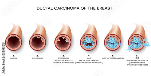 Ductal carcinoma of the breast, detailed medical illustration. At the beginning normal duct, then hyperplasia, after that atypical cells are invading. photo