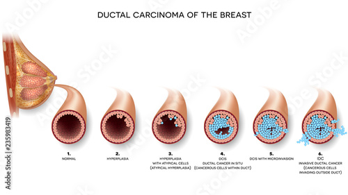 Ductal carcinoma of the breast cross section anatomy, detailed anatomy illustration. At the beginning normal duct, then hyperplasia, after that atypical cells are invading. photo
