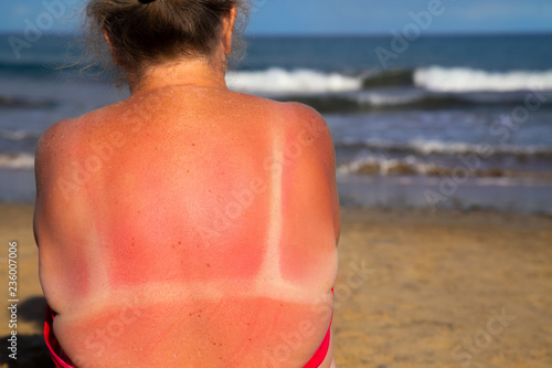 Canvas Print Mature woman in a bikini with sunburn on her shoulders