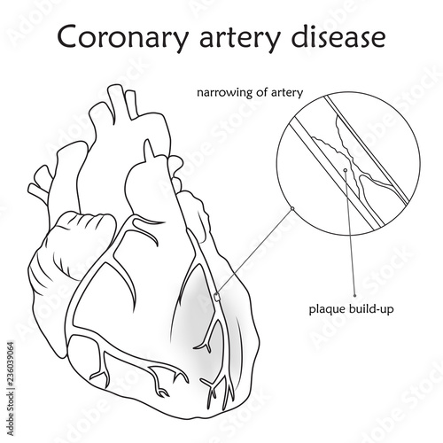 Coronary artery disease. Blocked artery, damaged heart muscle. Anatomy flat illustration. Outline image, white background.