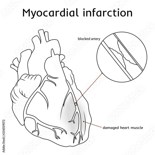 Myocardial infarction. Heart attack. Blocked artery, damaged heart muscle. Anatomy flat illustration. Red image, white background.
