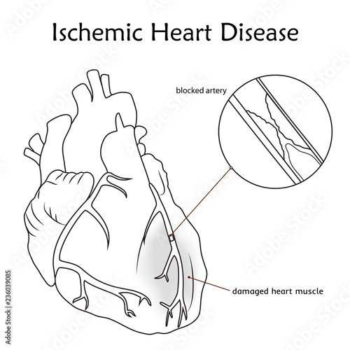 Ischemic Heart Disease. Blocked artery, damaged heart muscle. Anatomy flat illustration. Outline image, white background.