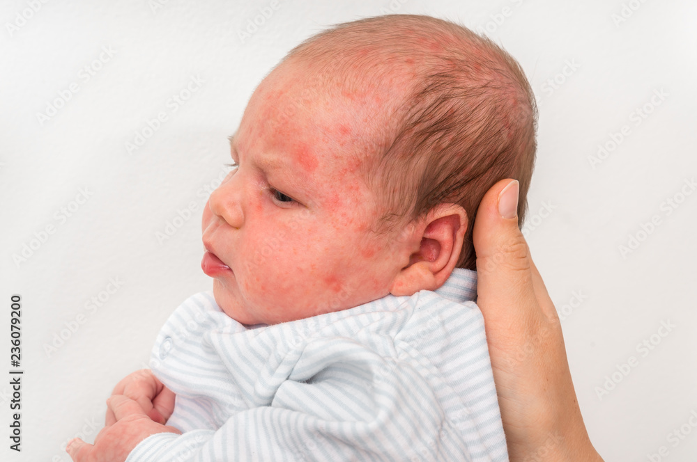 Newborn baby with skin rash. Allergic reaction after birth. Stock Photo ...