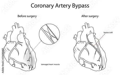 Coronary artery bypass, medical flat outline vector illustration. Damaged heart muscle, blocked artery, bypass craft.