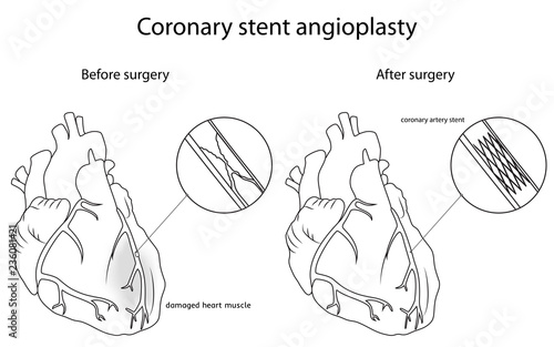 Coronary stent angioplasty, medical flat outline vector illustration. Damaged heart muscle, blocked artery.