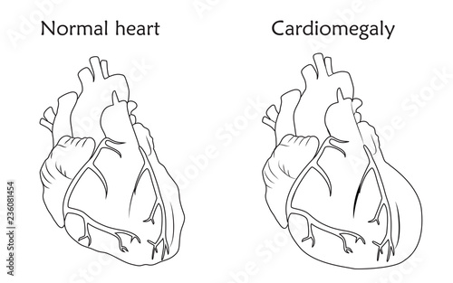 Cardiomegaly. Enlarged and normal heart muscles. Anatomy flat illustration. Outline image, white background.