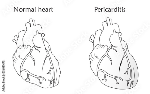 Pericarditis. Inflammation of the pericardium. Damaged and normal heart muscles. Anatomy flat illustration. Outline image, white background.